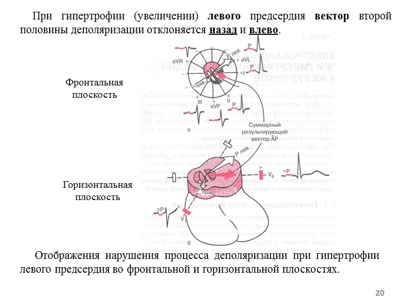 Отображения нарушения процесса деполяризации при гипертрофии левого предсердия во фронтальной и горизонтальной плоскостях. Отображения нарушения процесса деполяризации при гипертрофии левого предсердия во фронтальной и горизонтальной плоскостях.
